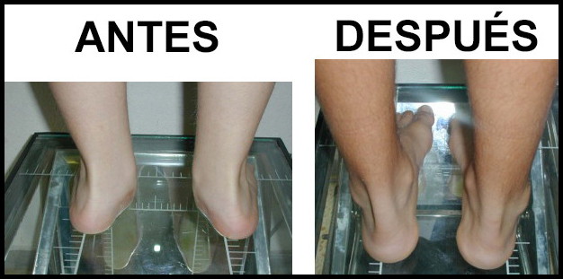 Pie plano valgo corregido con endortesis de Peek